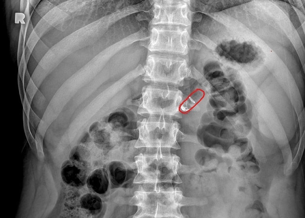 Rani Therapeutics Robotic Pill: Revolutionizing Subcutaneous Injections