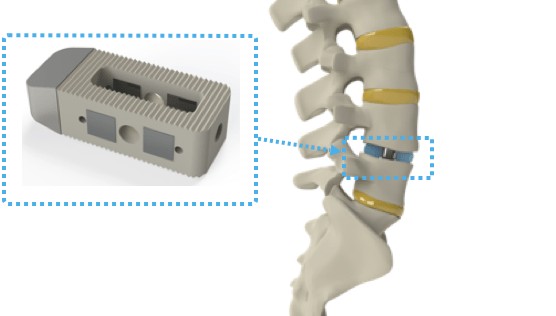 Intelligent Implants Secures $8.7M Funding for Spine Growth Technology